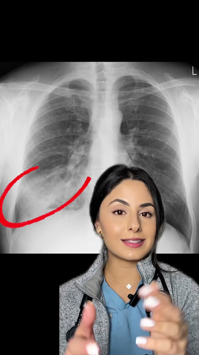 Chest X-Rays 🩻