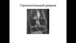 Базовый курс по МРТ    Лекция «МР семиотика повреждений коленного сустава»  Лектор  Катков А М