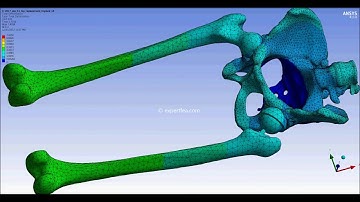 ANSYS WB Static Structural FEA - Legs movement simulation for hip replacement implant