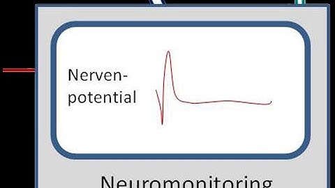 Multimodal Neuro monitoring