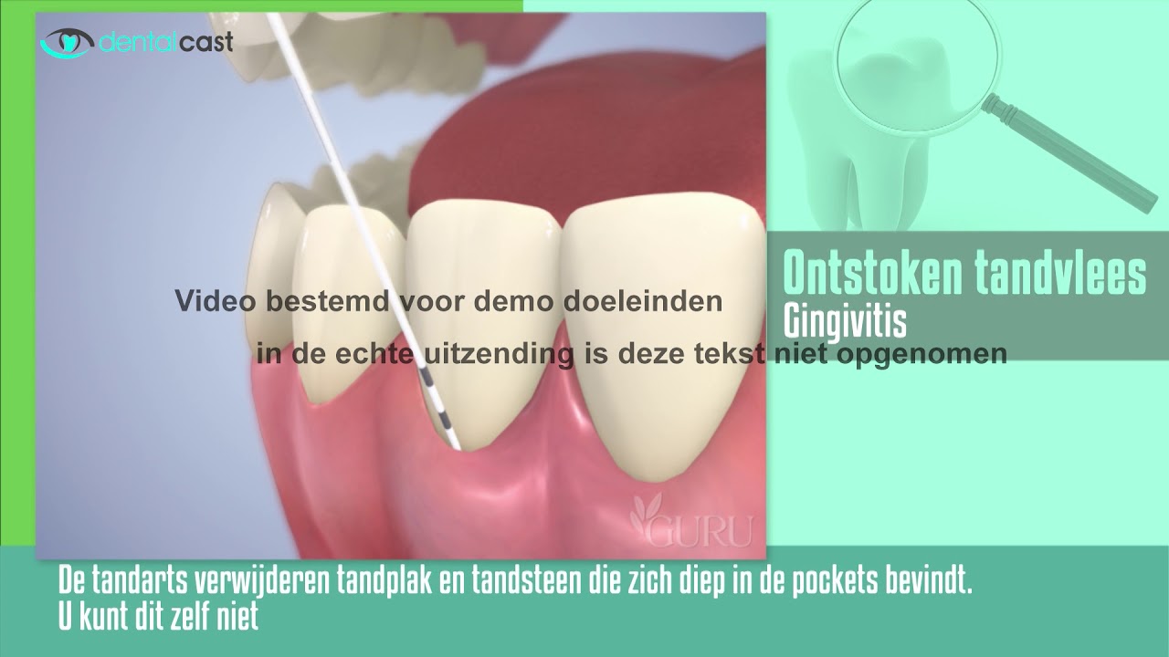 30 DD Gingivitis - YouTube