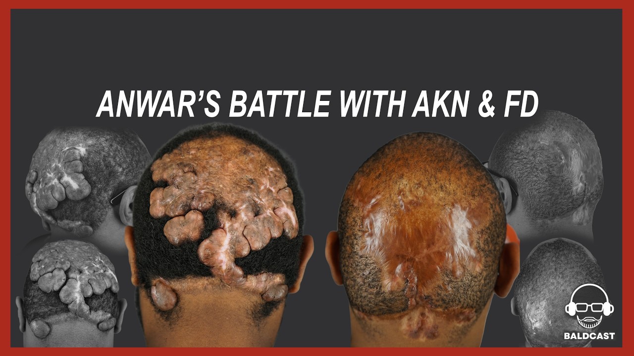 Anwar’s Severe AKN & Folliculitis Decalvans Journey | Full Baldcast Episode
