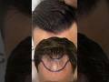 Hair Transplant Changed His Life- FUEGENIX