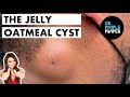 The Jelly Oatmeal Cyst