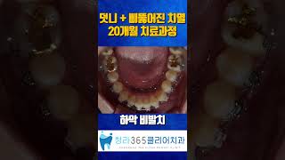 #청라365클리어치과 #덧니비발치교정 #청라교정 #청라치과 #치아교정