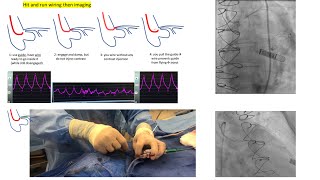 Aorto-ostial angiography and stenting: tips and tricks + case illustrations- Elias Hanna