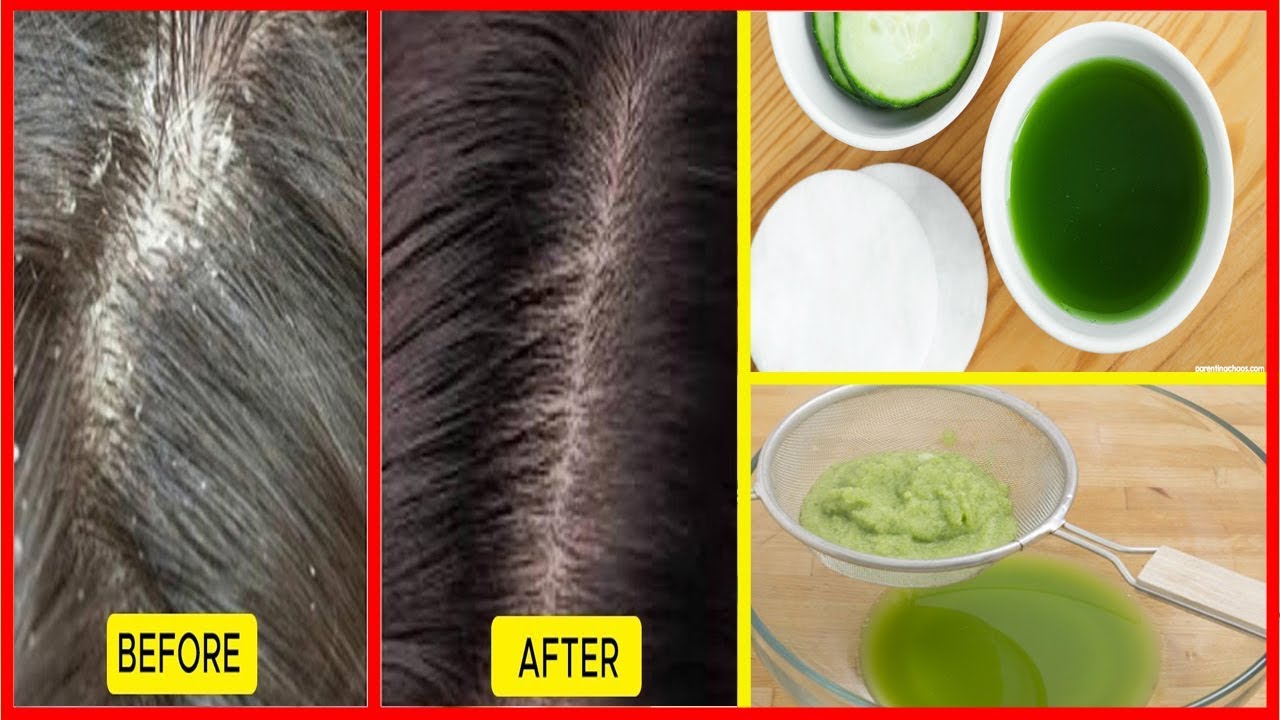 How to cure dandruff fast naturally at home Get rid of