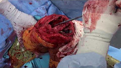 Porous Tantalum Femoral Metaphyseal Cones for Large Femoral Bone Defects in Revision Total Knee Arth
