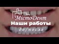 Сучасна Стоматологія у Львові - Лікування дорослих та дітей - МістоДент - Протезування зубів