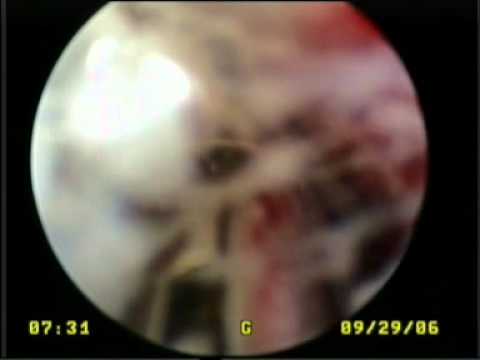 Videootoscopy in a dog , chronic otitis