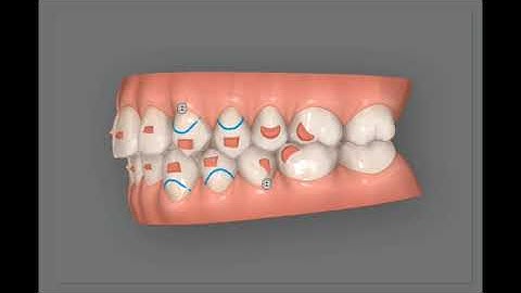 Invisalign clincheck. Treatment simulation to corect an open bite for adult patient