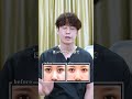 他院修正▶クマ取り 失敗例3選