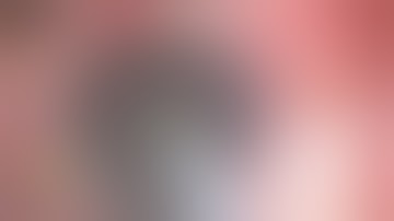 NvN  Phaco with IOL SCAFFOLD in  Phacolytic Cataract