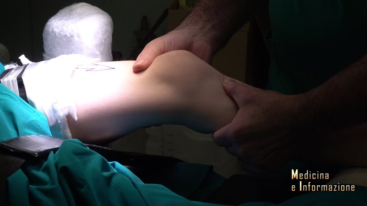 Rottura del legamento crociato anteriore