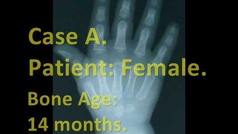 Radiological Case by Ricardo Arenas. Bone Age (3).