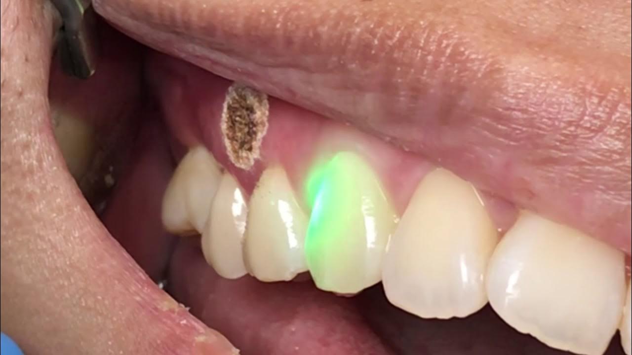 Is It Normal To Feel Sore After Tooth Filling