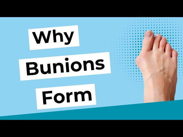 Foot and Ankle Problems By Dr. Richard Blake: Bunions: Tips on Conservative  Care