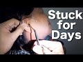 Stuck Cottons Removed From Woman's Ear | Got Stuck For Days!