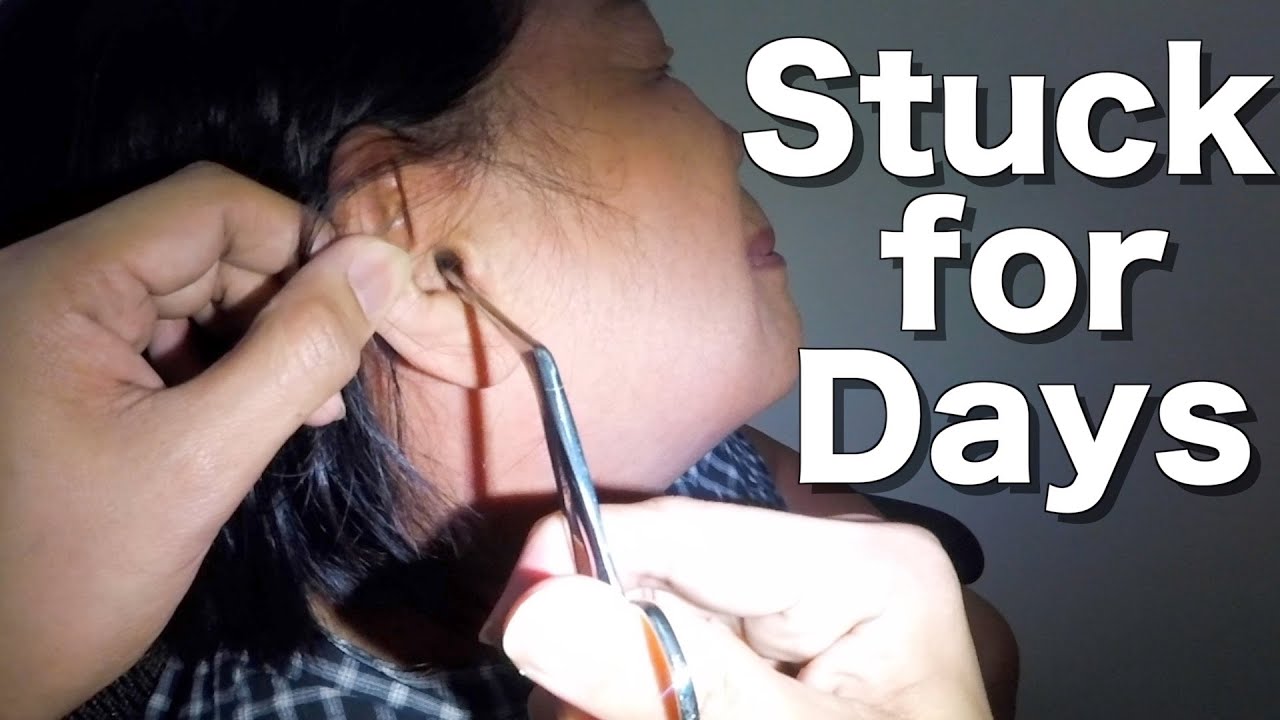 Stuck Cottons Removed From Woman's Ear Got Stuck For Days! YouTube