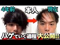 【4年間でおでこ/生え際がすごい事に】ハゲはどれだけ進行したのか?YouTubeを始めてからの過去を振り返ってみた