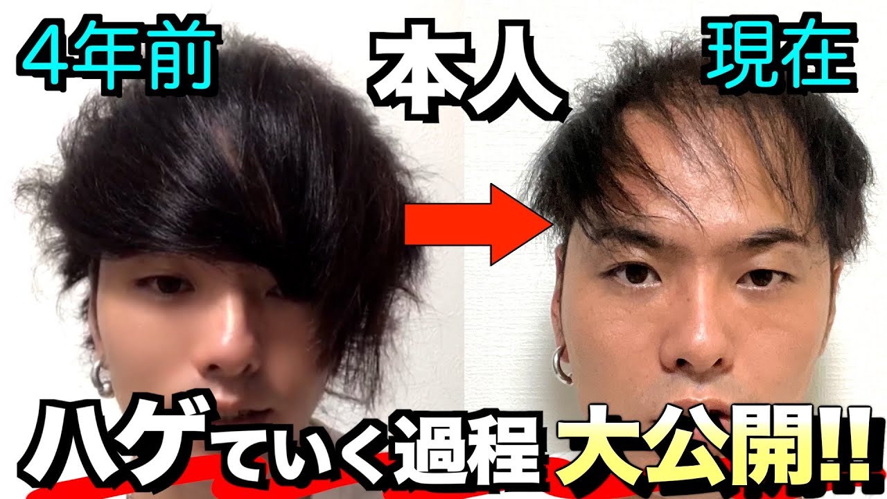【4年間でおでこ/生え際がすごい事に】ハゲはどれだけ進行したのか？YouTubeを始めてからの過去を振り返ってみた