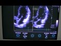 Measurements in 2D mode Ultrasound GE Vivid 3 Part 7