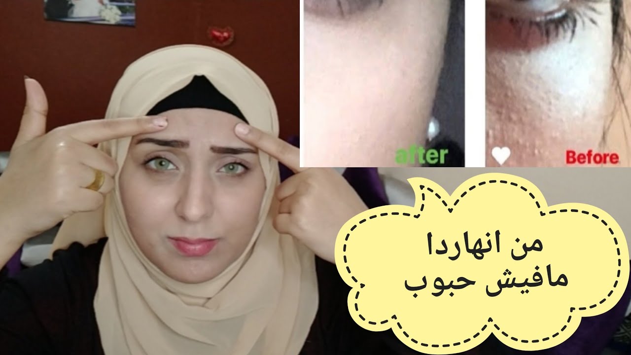 علاج نهائي للحبوب اللي تحت الجلد/واسباب ظهورها