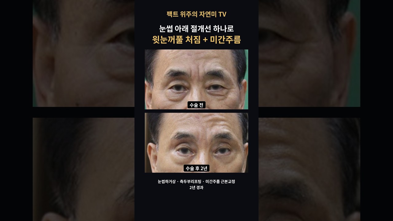 눈썹 아래 절개선 하나로 윗눈꺼풀·미간주름 교정, 2년 뒤 #눈썹하거상 #이마주름 #미간주름 #측두부리프팅 #shorts #연세자연미