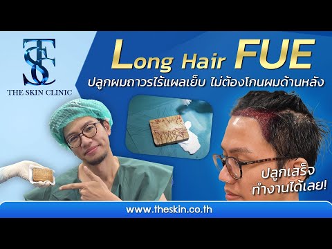 Long Hair FUE ปลูกผมถาวรไร้แผลเย็บ ไม่ต้องโกนผมด้านหลัง
