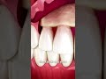 The surgery to reveal more teeth 