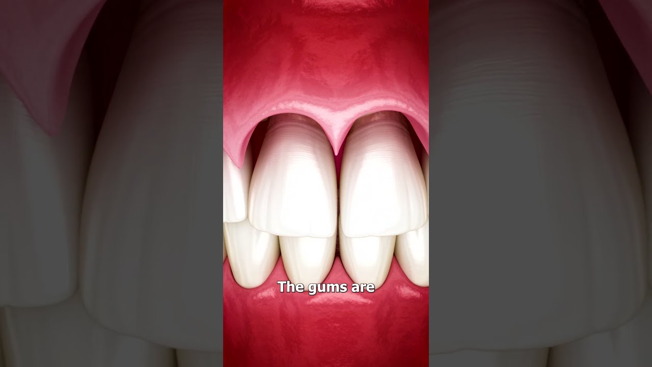 The Surgery To Reveal More Teeth 