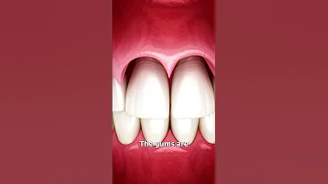 The Surgery To Reveal More Teeth 