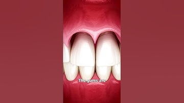 Thumbnail of The Surgery To Reveal More Teeth 😨