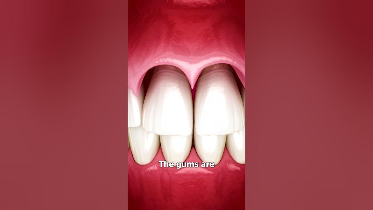 The Surgery To Reveal More Teeth 😨