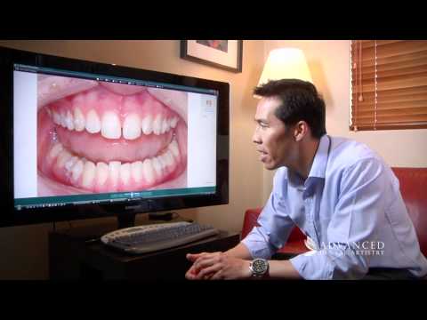 advanced-dental-artistry-----straightening-teeth-with-invisalign---cosmetic-and-dental-implant-team
