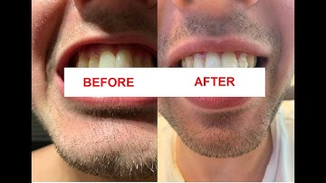 SPARK aligners Timelapse