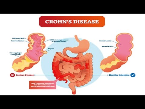 Video: Striktur Usus Pada Crohn's: Gejala, Pengobatan, Dan Banyak Lagi