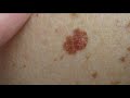 Idaho melanoma rates serve as reminder to protect skin