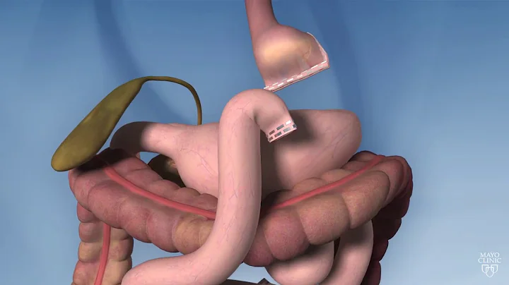 Roux-en-Y Gastric Bypass