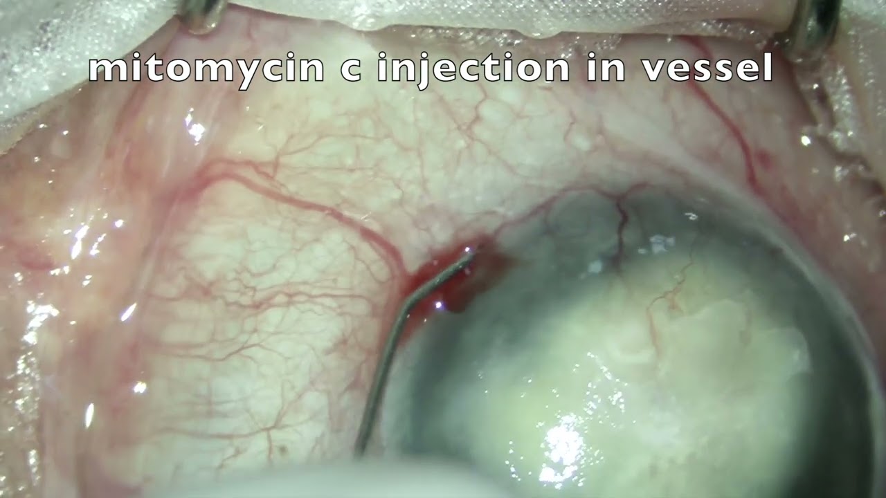M I C E - MITOMYCIN-C INTRAVASCULAR CHEMOEMBOLIZATION
