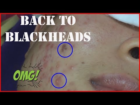 Blackheads, Whiteheads, Pimples And Cystic Acne Extraction Facial Treatment !!!