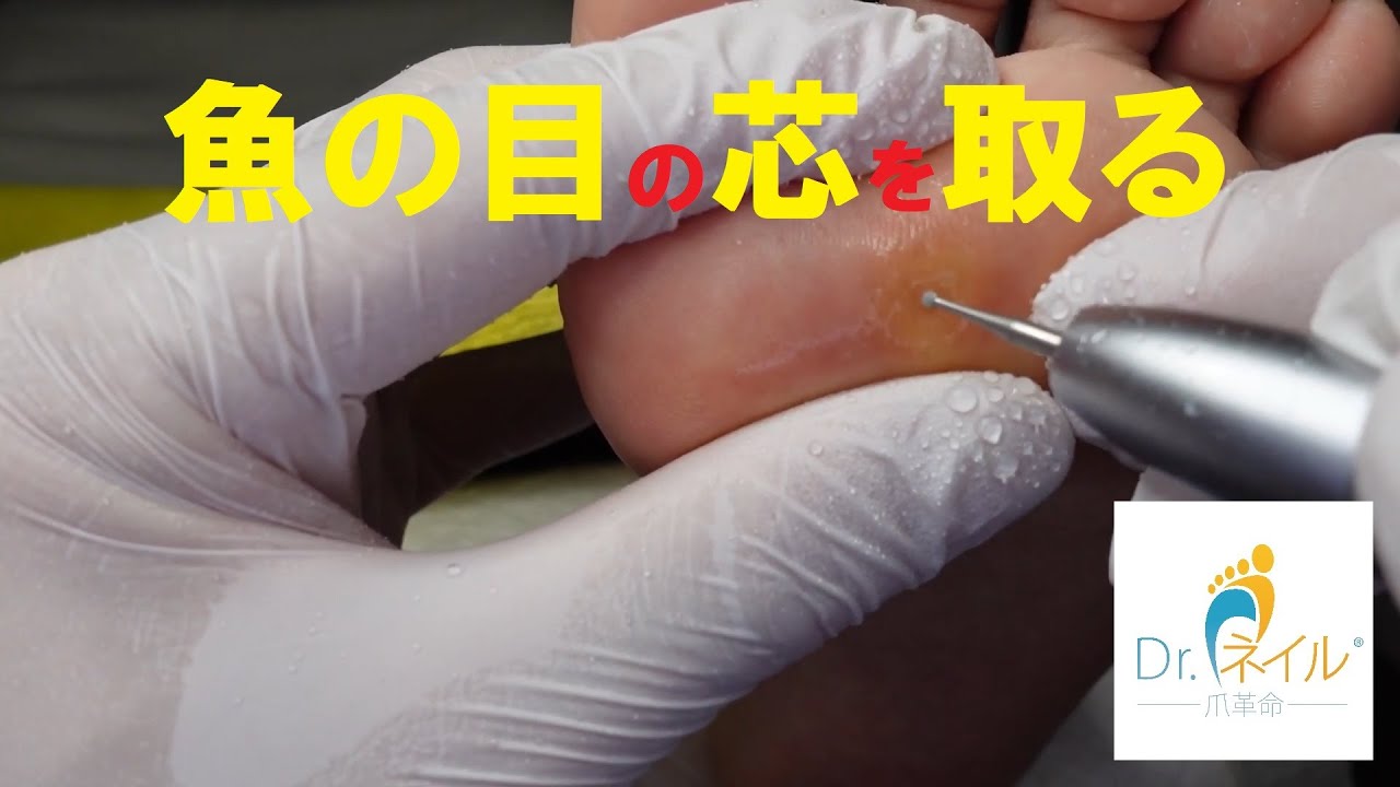 魚の目 の芯の取り方 胼胝 Callus 脚茧 うおのめ ウオノメ 魚の目 鶏眼 Corn 티눈 鸡眼 014 Youtube