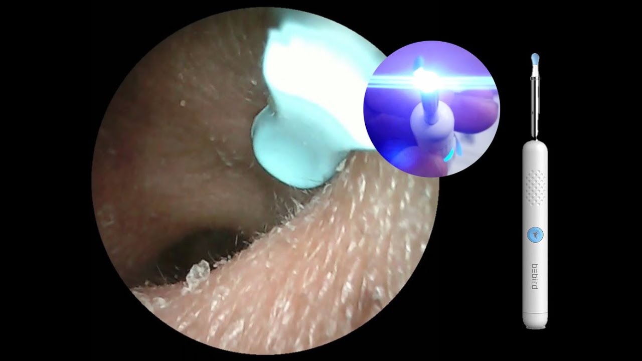 Ear Wax Remover Otoscope With 1080P Camera And 6 LED Lights Review ear-wax-remover-otoscope-with-1080p-camera-and-6-led-lights-review