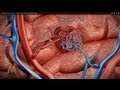 3D Medical Animation (HD) - Arteriovenous Malformation (Brain AVM)