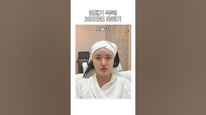 티타늄, 리프테라, 포텐자 레이저로 턱선, 이중턱 정리! 광채 리프팅 시술 후기