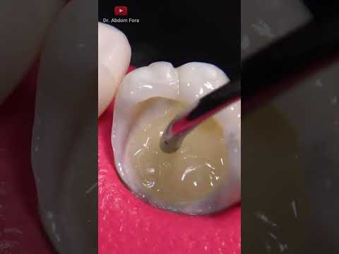 Video: 3 Cara Membalikkan Kerosakan Gigi