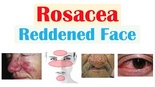 Rosacea (Red Lesions on Face) | Causes, Triggers, Types, Signs & Symptoms, Diagnosis, Treatment