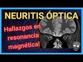 NEURITIS ÓPTICA {resonancia magnética} 👀