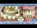Massive firm  hard black calculus removal by ultrasonic scaling i 1st dental cleaning in 35 years