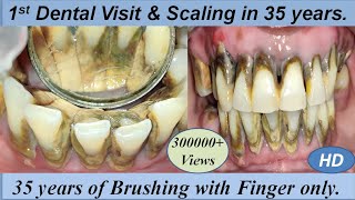 Massive Firm & Hard Black Calculus Removal by Ultrasonic Scaling I 1st Dental Cleaning in 35 years